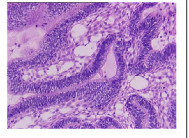 Gambar 4 : Ameloblastoma tipe follikular   (www. 