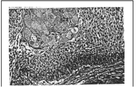 Gambar 7: Tipe sel granular (Sapp JP,  Eversole LR, Wysocki GP. Contemporary  Oral and Maxillofacial Pathology