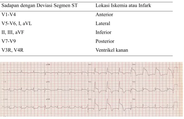 Tabel 3. Lokasi infark berdasar sadapan EKG