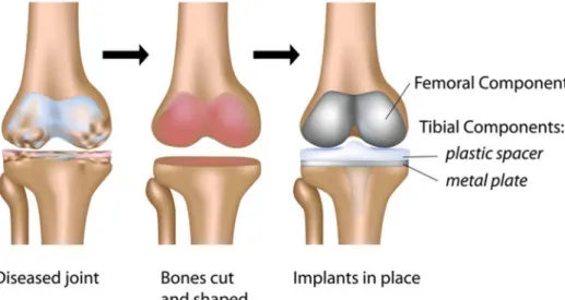 Gambar 1.1. Prosedur Total Knee Replacement (TKR) 