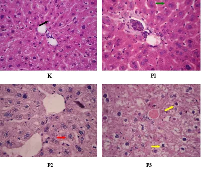 Gambar 1. Gambaran histopatologi hepar tikus Wistar (400x). (  ) : sel hepar normal. (  ) : degenerasi parenkimatosa sel hepar.(  ) : degenerasi hidropik sel hepar