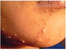 Gambar 6. Dermatitis perioral 