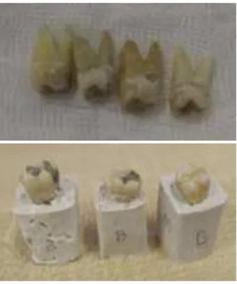 Figure 1: Right; Samples that had been cleaned, disinfected and autoclaved. GIC restoration was placed on the tooth with gross caries on enamel, Left;  The teeth that had been mounted into a block made of Plaster of Paris with sawdust, then labelled to ease the identiication process.