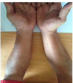 Gambar 1. Dermatitis Kontak Pada Tangan Fase Akut 