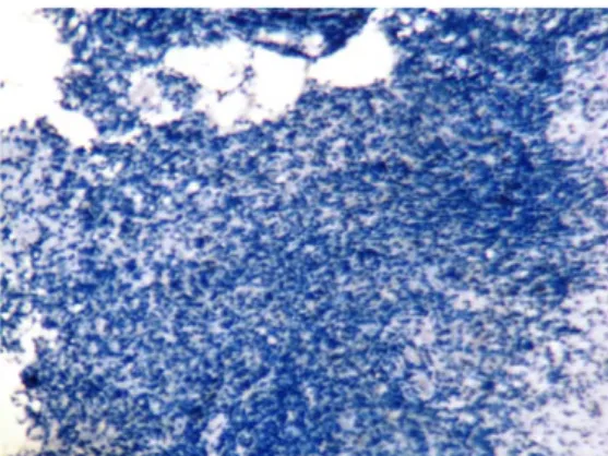 Gambar 11. Pewarnaan immunohistokimia TNF-αskor 0 (negatif) pada  jaringan KNF dengan pembesaran x100 