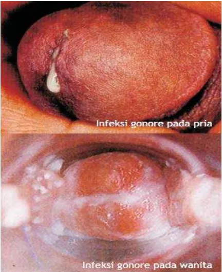 Gambar 1. Infeksi bakteri akibat Gonore 