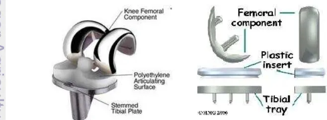Gambar 1  Endoprostetik pada sendi lutut.5,6