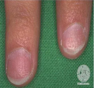 Gambar 2. Pitting nail pada psoriasis 