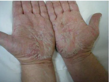 Gambar 2. Dermatitis Kontak Pada Tangan Fase Kronik 