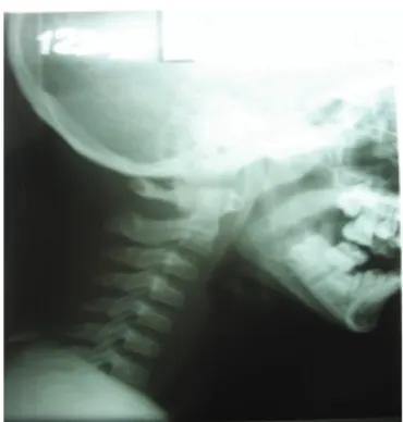 Gambar  Foto Rontgen Lateral Tulang      Servikal Normal