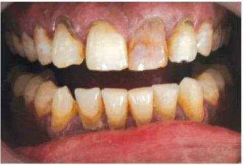 Gambar 1. Tampak diskolorasi pada gigi 21 dengan nekrosis pulpa2