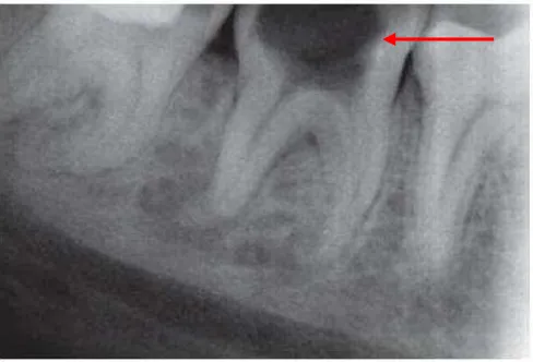 Gambar 3. Dekomposisi gigi sebagai akibat nekrosis pulpa2