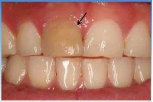 Gambar 4. Kurangnya translusensi normal pada gigi 1117 