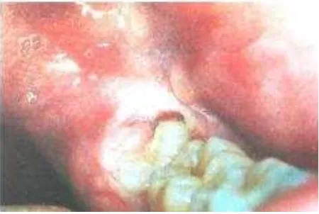 Gambar 2. Perikoronitis akibat gigi impaksi.20 