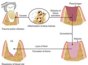 Gambar 2. Patogenesis alveolar osteitis30 