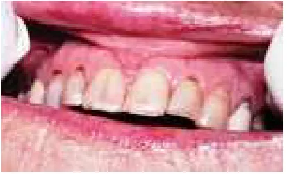 Gambar 1. Lidah kering dan pecah-pecah20 