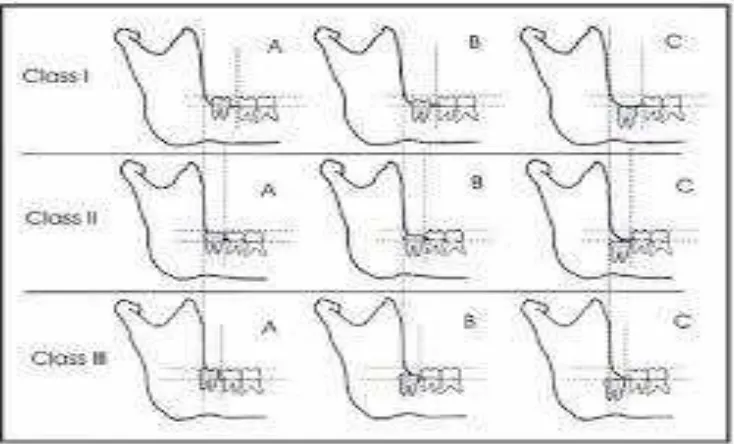 Gambar 1. Klasifikasi impaksi gigi molar ketiga menurut Pell & Gregory9 