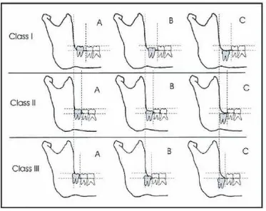 Gambar 2. Klasifikasi impaksi gigi molar ketiga menurut Pell & Gregory. 2 