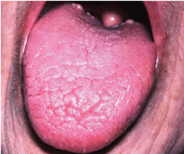Gambar 1. Xerostomia 20   
