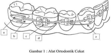 Gambar 1. Komponen Pesawat Ortodonti Cekat11