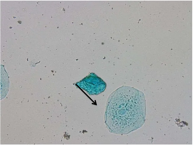 Gambar 7. Sel dengan mikronukleus pada kelompok perokok 