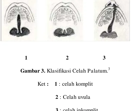 Gambar 3. Klasifikasi Celah Palatum.3 