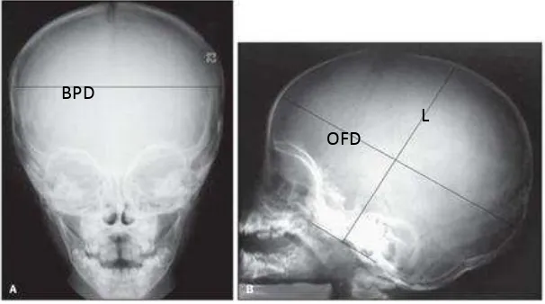 Gambar 2. Foto x-ray kepala cranial size 