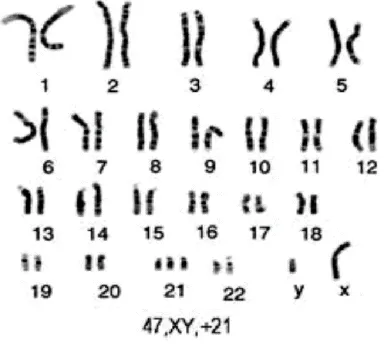 Gambar 1. Kromosom 21. Dikutip dari Chen.22 