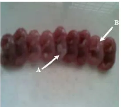 Gambar 2. Gambaran fetus pada pembedahan dihari ke-19. (A) gambaran berwarnaputih di bawah kulit pada daerahabdominal