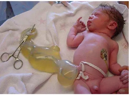 Gambar 4. Manifestasi postnatal dari Giant, Cystic, Umbilical Cord dengan tali 