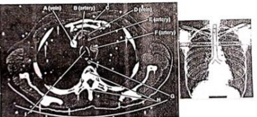 Gambar 2.12.Posisi irisan  Thorax dan garis irisan CT- ScanAxial  3( Bontrager,KL,20) 