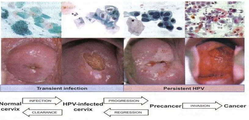 Gambar 4. Progressivitas kanker serviks uteri26