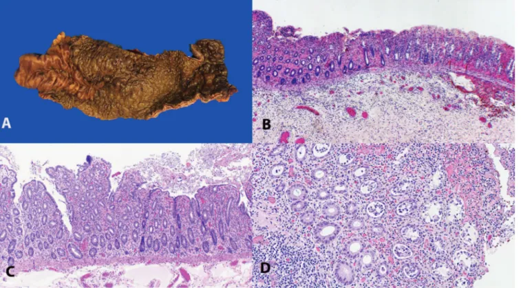 Figure 1. Ischemic colon in the setting of coronavirus disease 2019 (COVID-19) infection