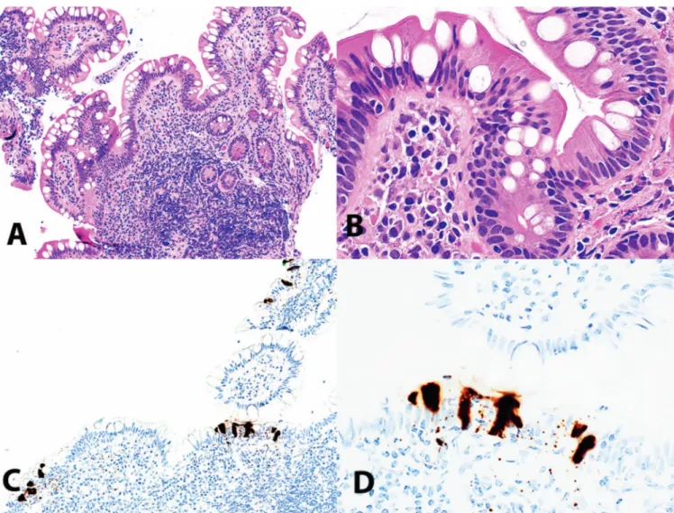 Figure 2. Terminal ileum biopsy in a patient with coronavirus disease 2019 (COVID-19)