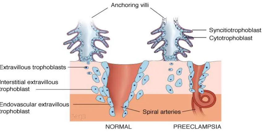 Gambar 1. Invasi trofoblas pada kehamilan normal dan preeklampsia A. Implantasi plasenta normal pada trimester III menunjukkan proliferasi trofoblas ekstravilus pada vilus anchor