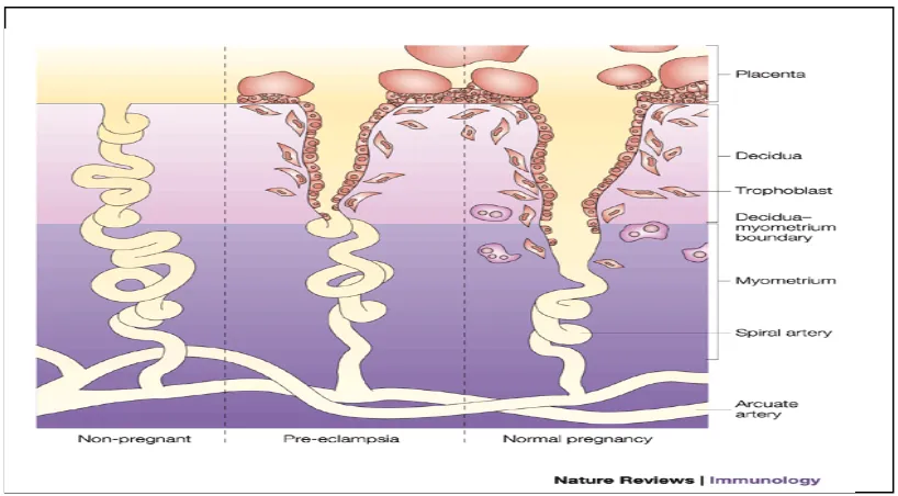 Gambar 1. Invasi trofoblas pada kehamilan normal dan preeklampsia7