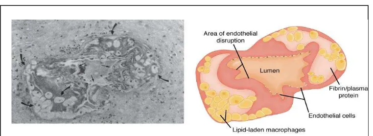 Gambar 2. Atherosis pada pembuluh darah placental bed22