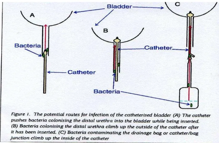 Gambar 1. Rute infeksi melalui melalui kateterisasi 