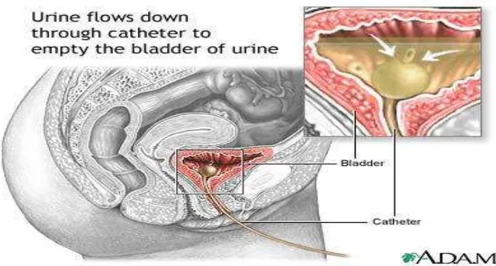 Gambar 2. Pemasangan kateterisasi uretra pada kandung kemih wanita 