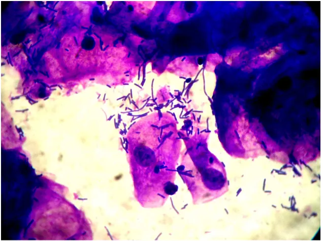 Gambar 1. Hasil pengecatan Gram sekret vagina Normal