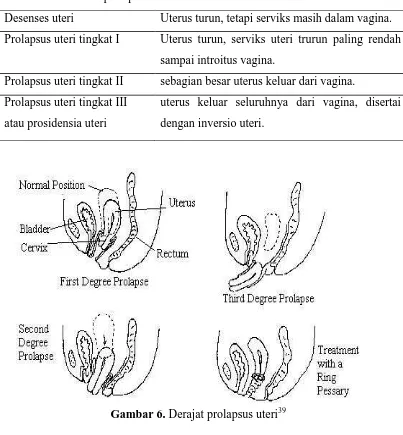 Tabel 4. Klasifikasi prolapsus uteri9