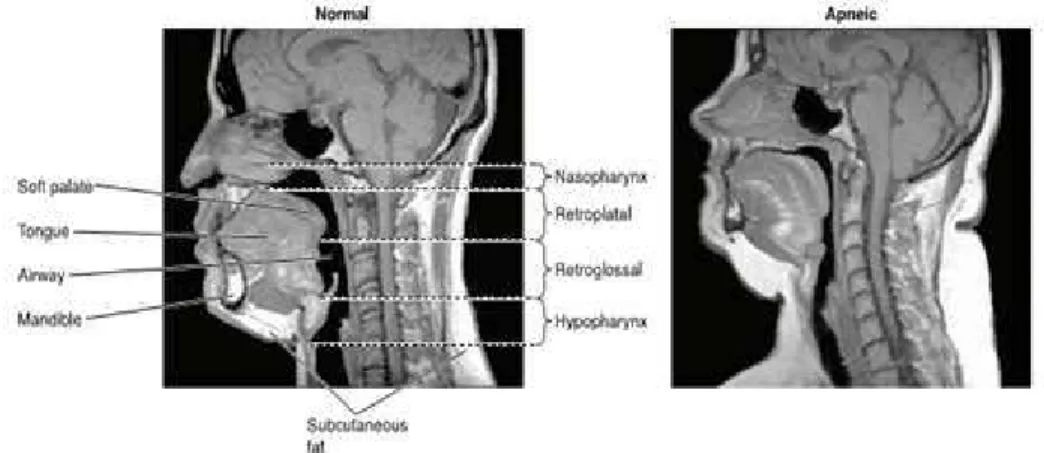 Gambar 1. Mid Sagital Magnetic Resonance Imaging (MRI) pada subjek normal dan subjek  OSAS 27