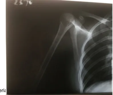 Gambar 8. Hasil radiografi shoulder b. Kriteria Gambar :