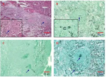Gambar 4. Dermatitis granulomatosa (H & E) (A), invasive hypaeFigure 4. dan mycotic dermatitisgranulomatosa (GMS) pada jaringan otot ikan gurame (Osphronemus gouramy) (B& C), dan invasive hypae serta melano macrophage center (MMC) pada ginjal (D)Dermatitis granulomatosis (H & E) (A), invasive hypae and mycotic dermatitisgranulomatosa (GMS) on the muscle tissue of giant gouramy (Osphronemusgouramy) (B & C), invasive hypae and melano macrophage center (MMC)existed on the kidney (D)