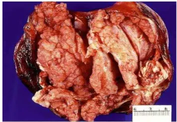 Gambar 9. Kistadenokarsinoma serosa, tumor tampak solid dengan daerah nekrotik dan hemoragik (dikutip dari Rosai J