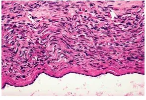 Gambar 11. Kistadenokarsinoma serosa (dikutip dari Rosai J. Rosai and Ackerman’s Surgical Pathology) 