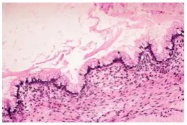 Gambar 14. Kistadenoma musinosa, tampak sel goblet (dikutip dari Rosai J. Rosai and Ackerman’ Surgical Pathology) 