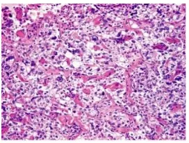 Gambar 21. Clear cel carcinoma,                                                                                                         tampak struktur papiler (dikutip dari Rosai J.Rosai and Ackerman’s Surgical Pathology) 