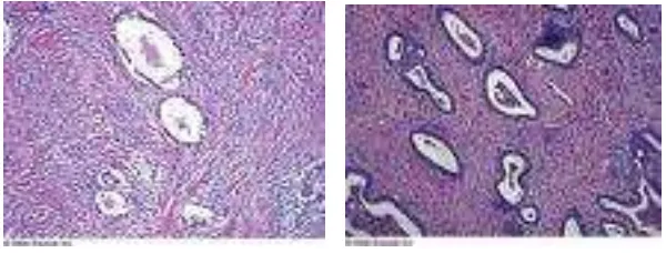 Gambar 23. Makroskopik Kistadenofibroma                (dikutip dari Rosai J. Rosai and Ackerman’s Surgical Pathology) 