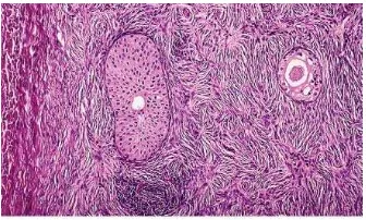 Gambar 25.Makroskopik Tumor Brenner (dikutip dari Rosai J. Rosai and Ackerman’s Surgical Pathology)  